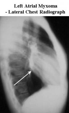 Lateral chest radiograph shows prominence of the l