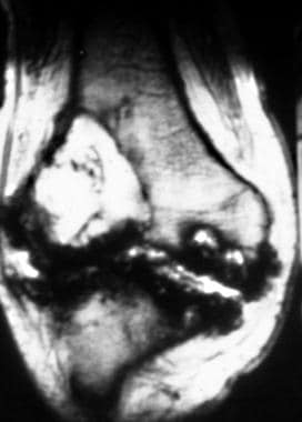Coronal T2-weighted magnetic resonance image of th