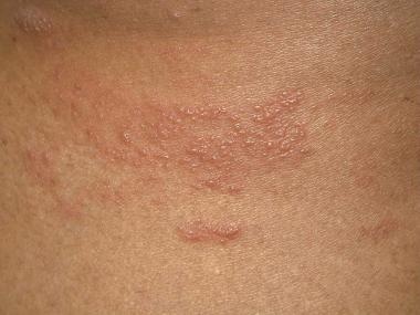 Mild Herpes Rash - Doctor insights on HealthTap