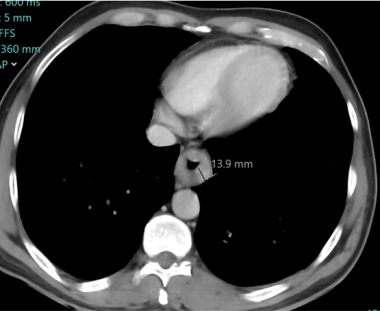 Axial enhanced CT scan of an 80-year-old man compl