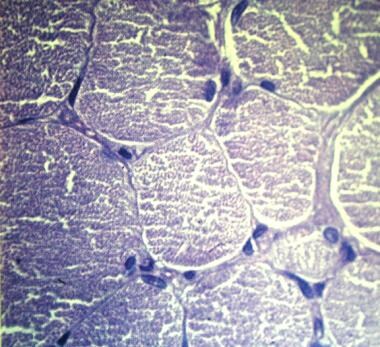 Spinal muscle atrophy, Kugelberg-Welander disease.