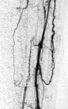 Lower-extremity arteriogram of peroneal and tibial