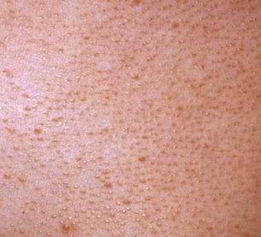 The lesions of keratosis pilaris are evenly spaced