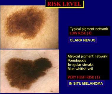 A low-risk melanocytic lesion with a typical pigme
