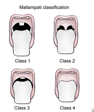 Mallampati classification. 