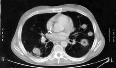 CT scan of a patient with invasive aspergillosis s