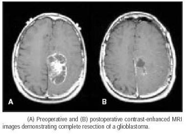 Glioblastoma multiforme (GBM) before and after sur