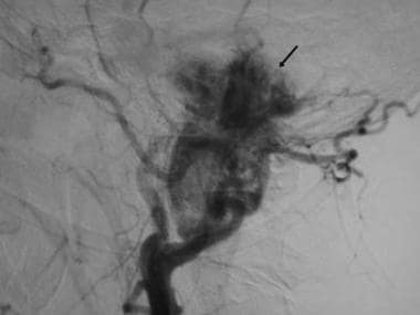 Glomus jugulare. Digital subtraction angiogram sho