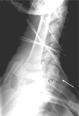 To better evaluate the lower cervical spine, a lat