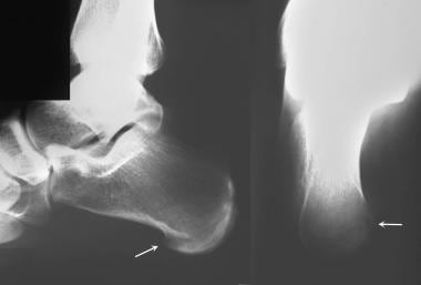 Calcaneus, fractures. Lateral and axial radiograph