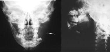 Eosinophilic granuloma. Anteroposterior radiograph