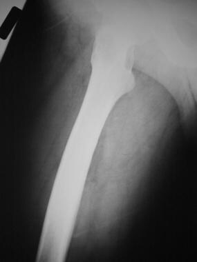 Lateral radiograph of the femur in a 45-year-old m