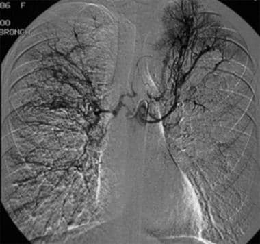 Contrast agent injection in the common bronchial a