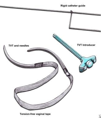 Tension-free vaginal tape (TVT). TVT device comes 