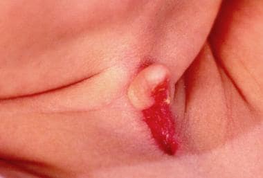 Close-up view of 3-week-old patient with congenita