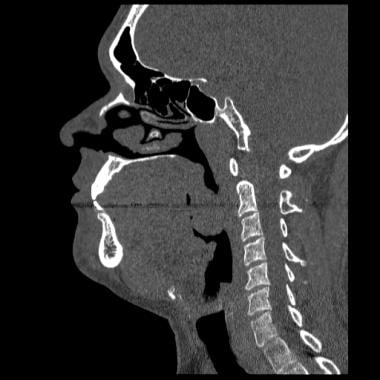 Tonsillar hypertrophy in a 34-year-old male, shown