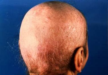Favus of the scalp shows extensive lesions with sc