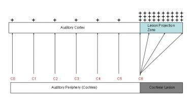 Tinnitus model. Two phenomena in auditory cortex a