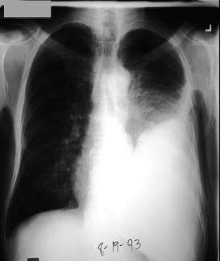 Left pleural effusion developed 4 days after antib