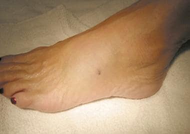 stingray foot wound puncture barb injury clinical typical envenomation presentation meade md john approximately minutes after