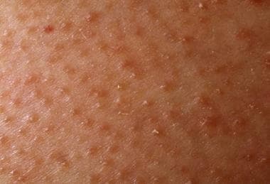 Close examination of keratosis pilaris shows kerat