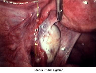 Infertility. Uterus - Tubal ligation. Image courte