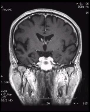 Coronal, T1-weighted magnetic resonance imaging (M