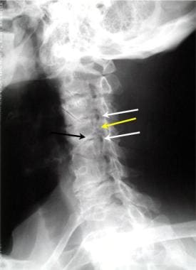 Oblique view of the cervical spine demonstrates 2 