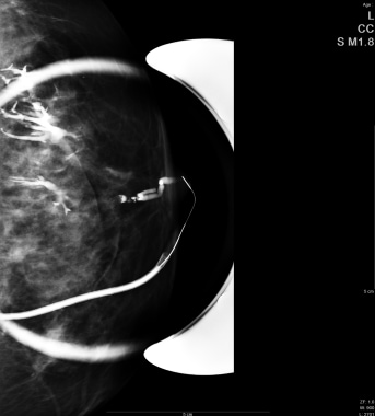 Mammographic spot image during a ductogram shows c