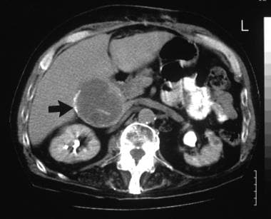 A transaxial enhanced CT scan of a 60-year-old man