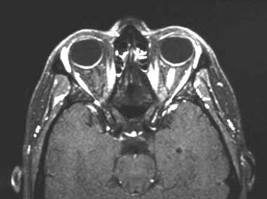 A 43-year-old woman with acute vision loss and eye