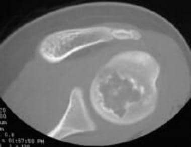 Axial computed tomography scan of a humeral head c