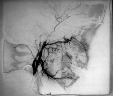Eosinophilic granuloma. External carotid angiogram