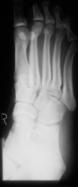 Fractured metatarsals. Oblique view of a normal fo