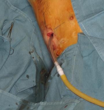 Connection of the chest tube to a drainage system.