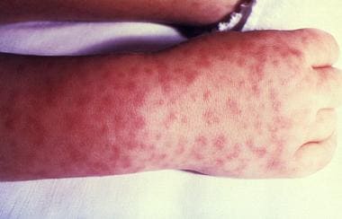 Rocky Mountain Spotted Fever (RMSF) rash in a chil