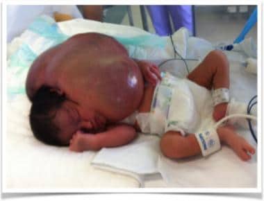 Newborn with massive macrocystic lymphatic malform