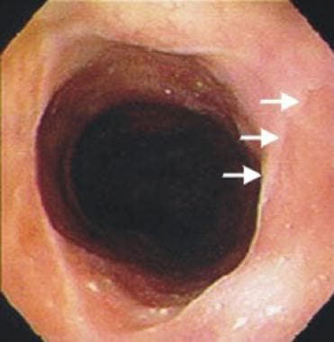 Postcricoid esophageal web and an inlet patch (arr