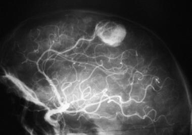 Supratentorial hemangioblastoma proved by histolog