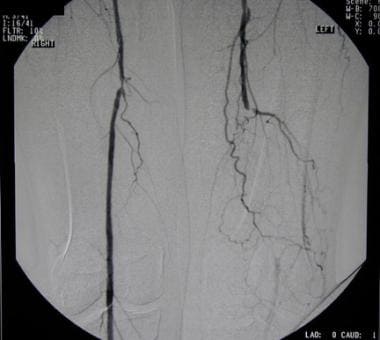 Peripheral arterial occlusive disease. Angiogram s