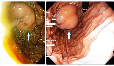 Fundal varices seen on endoscopic examination of t