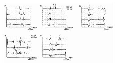 Electromyographic (EMG) evaluation of the motor un