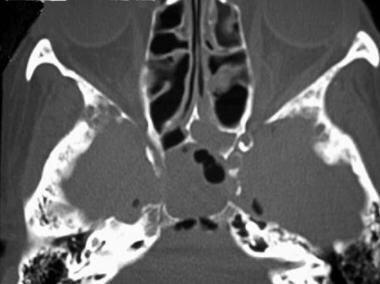 Axial CT image demonstrates pneumocephalus in asso