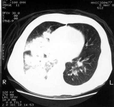 Chest CT image reveals patchy, dense lung opacific