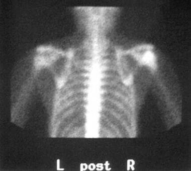 Bone scan of a humeral head chondroblastoma in a 1