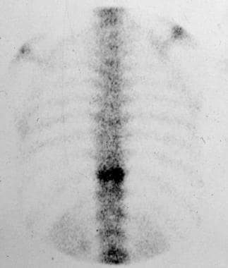 Radioisotope scan of the thoracic spine in a 56-ye