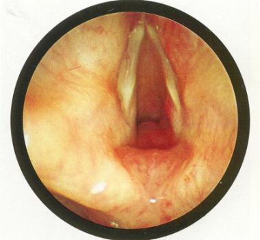 Endoscopic picture of subglottic hemangioma. Used 