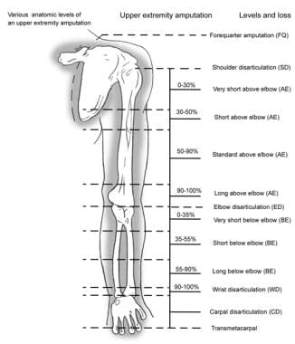 The various levels of an upper extremity amputatio