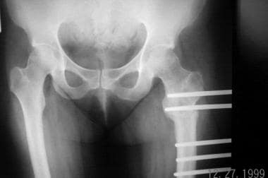 Proximal femoral osteotomy was performed and the h