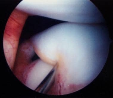Arthroscopic appearance of complete discoid latera